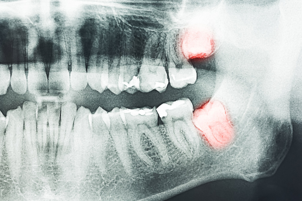 teeth Digital X-Rays